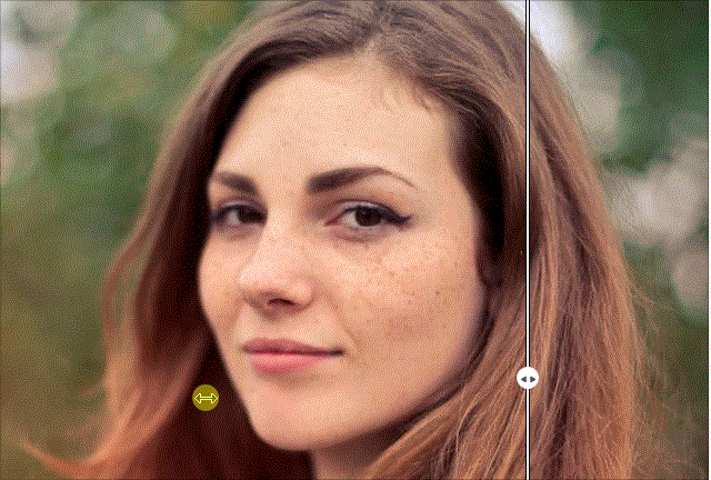 去除雀斑前后对比