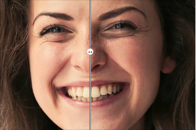 美白牙齿前后效果对比