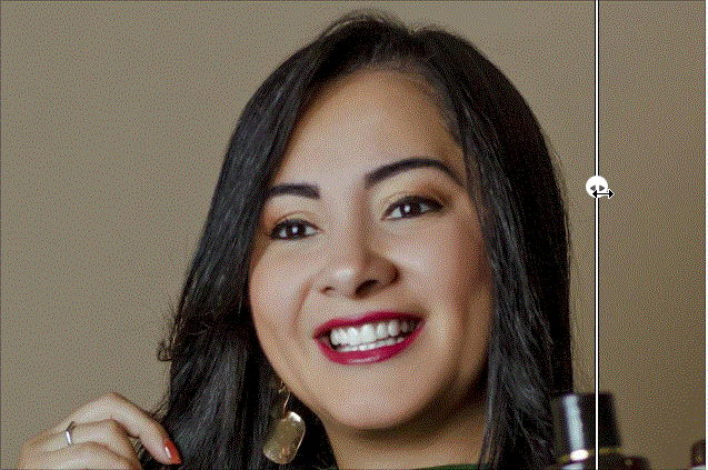 修双下巴前后对比