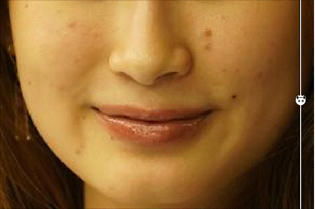 去除法令纹效果